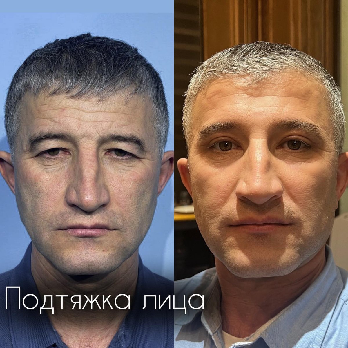 Эндоскопическая подтяжка лба и бровей result 1