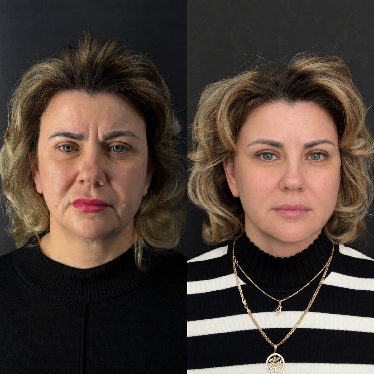 ПОДТЯЖКА ЛИЦА